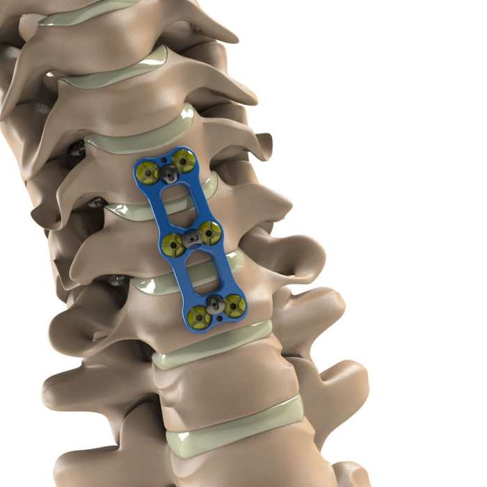 Cpt code for triple arthrodesis