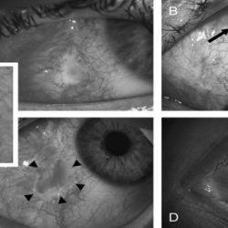 Epithelialization contraction wounds wound epithelialized accelerated