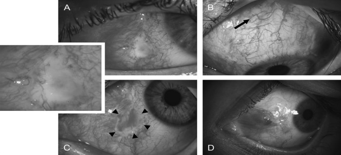 Epithelialization contraction wounds wound epithelialized accelerated