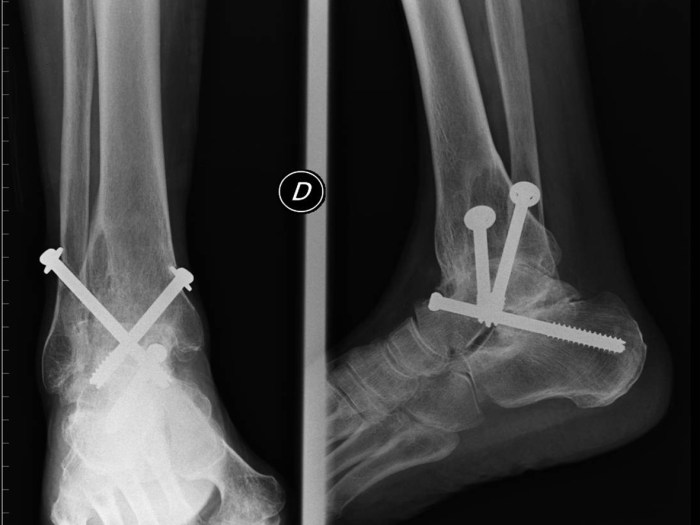 Cpt code for triple arthrodesis