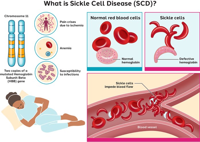 Which statement accurately describes sickle cell anemia