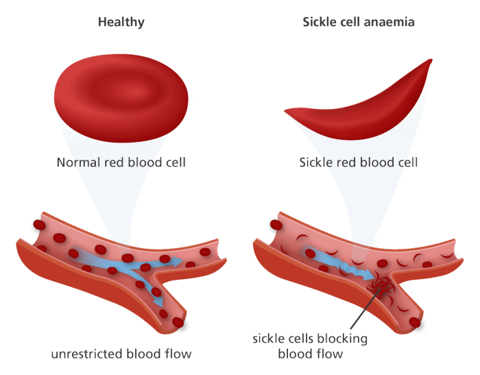 Sickle anemia cell blood cells shaped