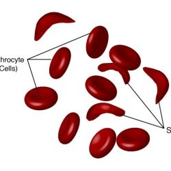 Which statement accurately describes sickle cell anemia