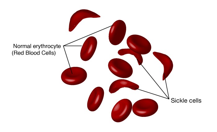 Which statement accurately describes sickle cell anemia